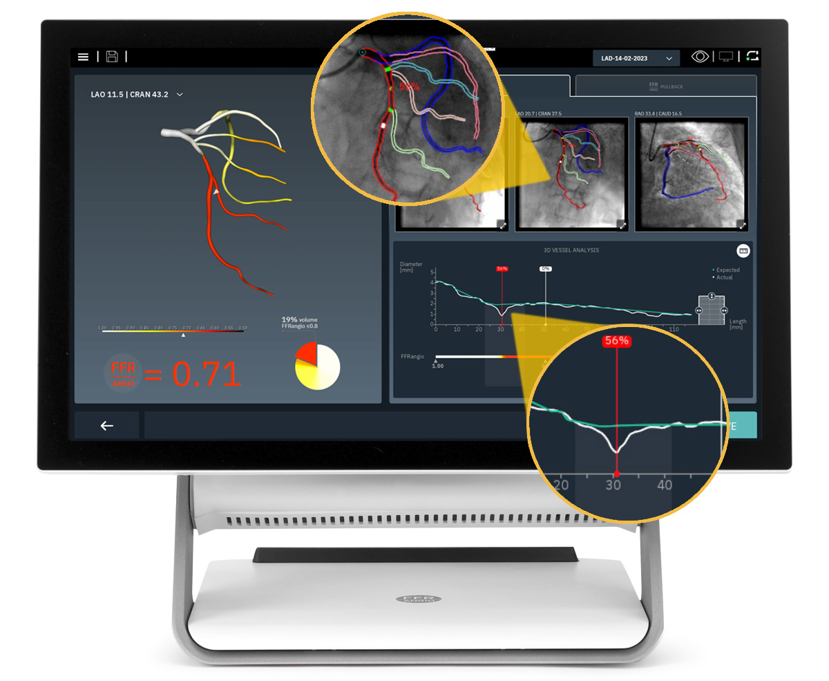 CathWorks FFRangio System - Results
